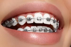 Orthodontic Treatment Dubai - Dr. Paul's Dental Clinic